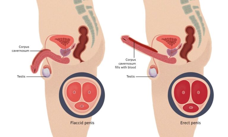 shockwave therapy