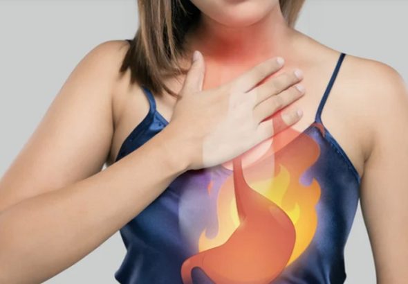 GERD Acid Reflux
